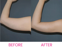 Viscera X Before After 1