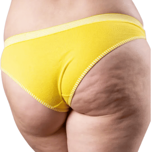 Saggy Buttocks 12